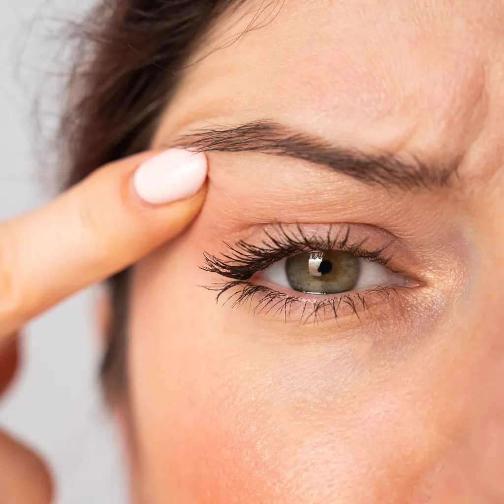 Correction des paupières tombantes — blépharoplastie